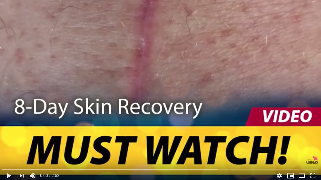 MUST WATCH! 8-Day Skin Recovery after surgery using Colostrum!